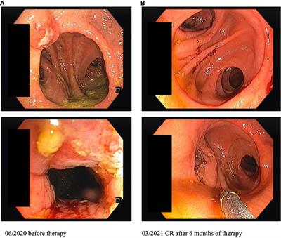 Case report: Durable complete response of a mucosal melanoma of the rectum after neoadjuvant immunotherapy with ipilimumab plus nivolumab